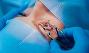 Chirurgie de la Cataracte