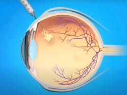 Les Injections Intravitréennes