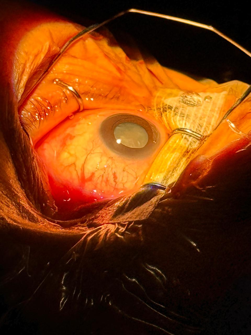 Chirurgie cataracte: consultez votre Ophtalmologue Fès