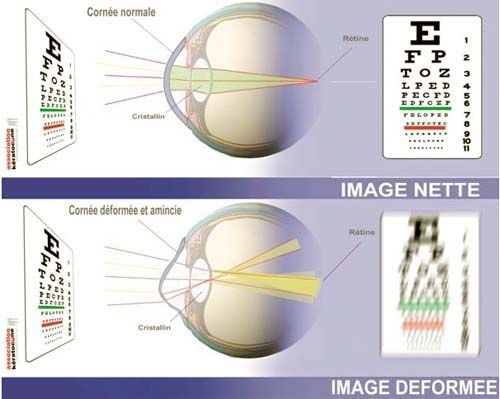 Ophtalmologue Fès : solutions pour le kératocône