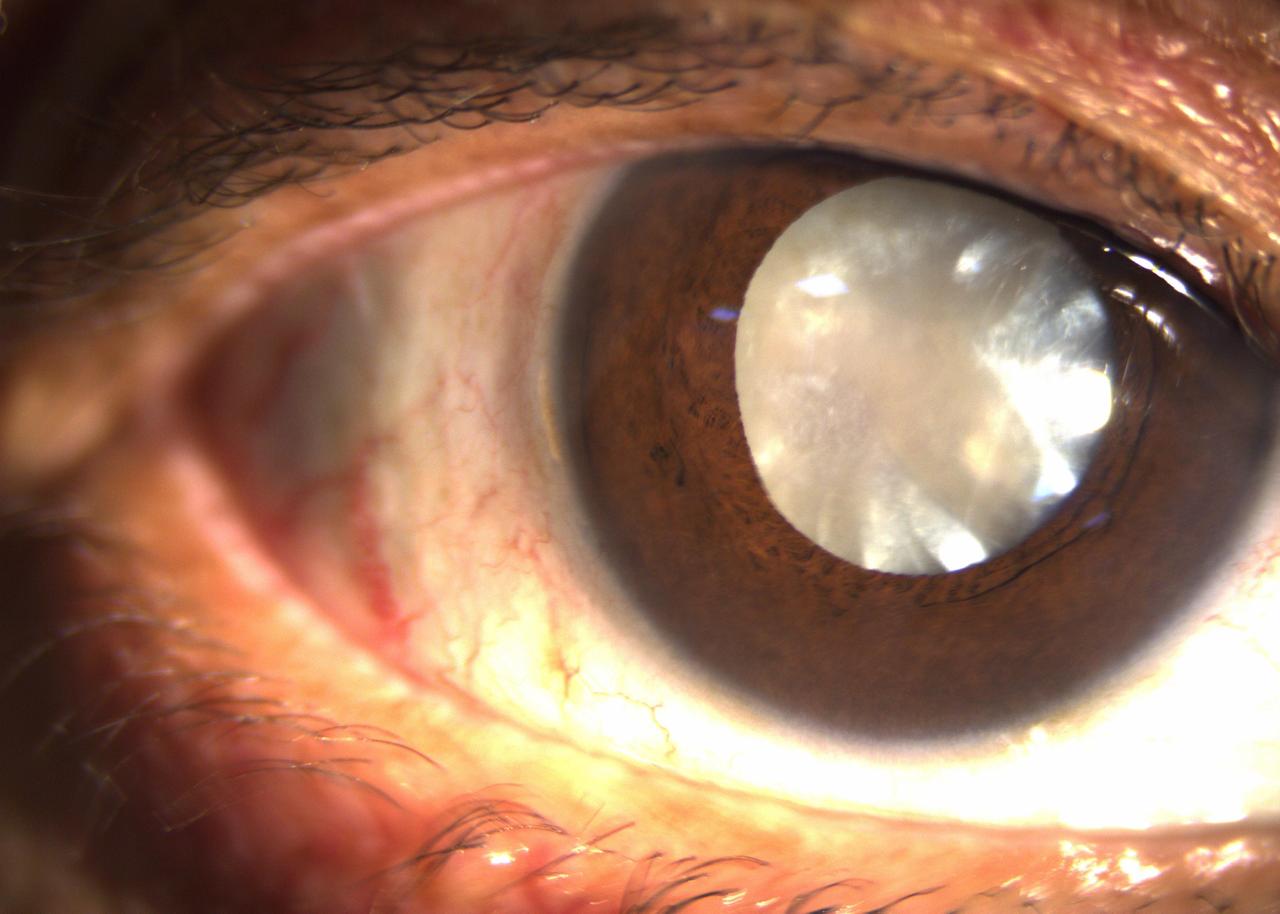 Ophtalmologue à Fès : que faire en cas de cataracte avancée ?