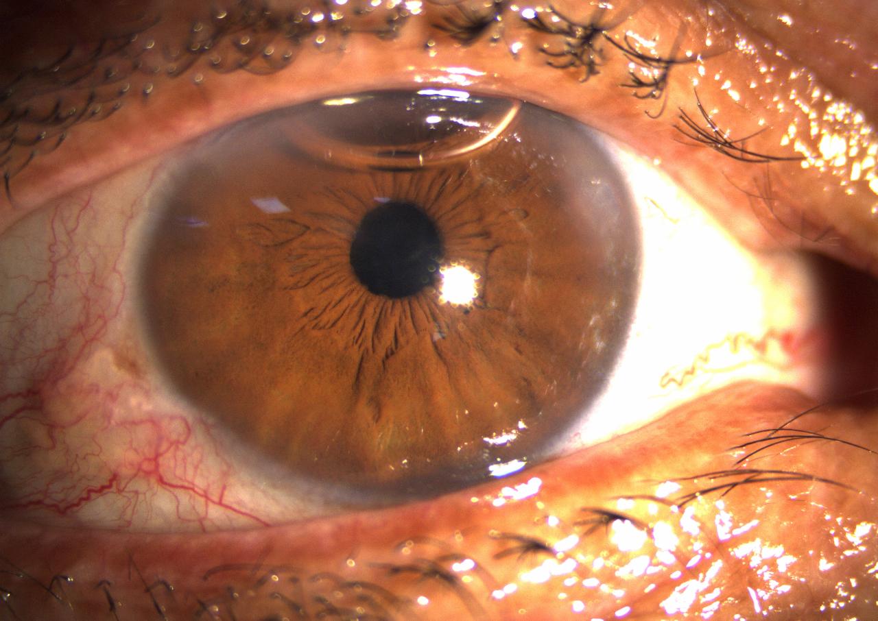 Chirurgie cataracte : suivi avec Ophtalmologue Fès