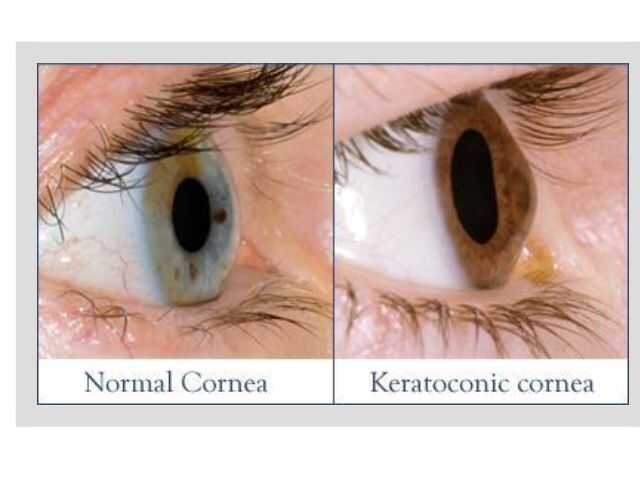 Kératocône Fès : Ophtalmologue à Fès