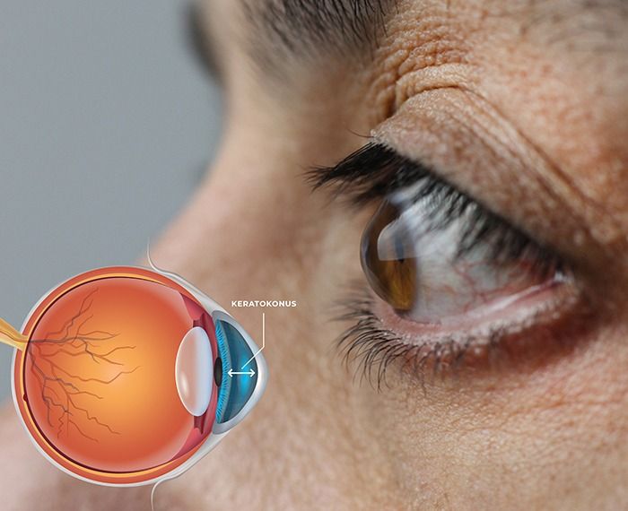 Kératocône Fès : Ophtalmologue à Fès