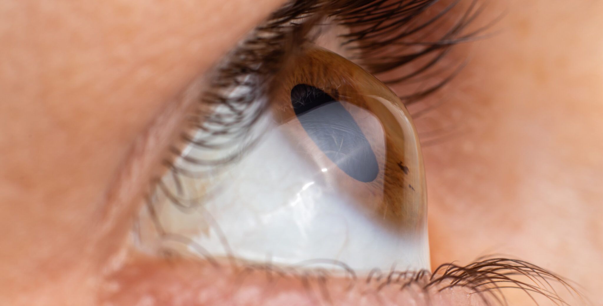 Kératocône à Fès : traitements personnalisés