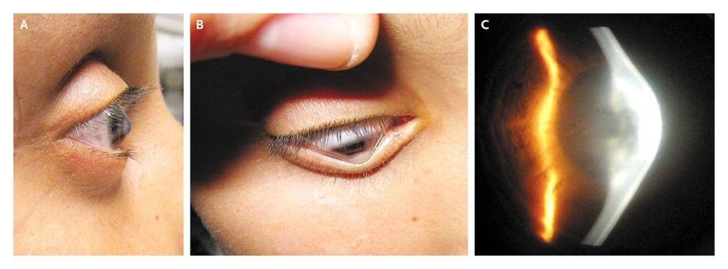 Traitement du kératocône à Fès : ophtalmologue spécialisé