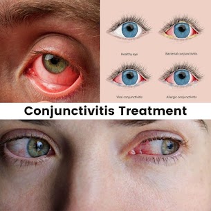 Infection des yeux : quand consulter un ophtalmologue ?